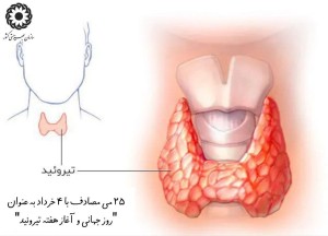 کم‌کاری تیروئید نوزادی مهم‌ترین عامل عقب‌ماندگی ذهنی در نوزادان